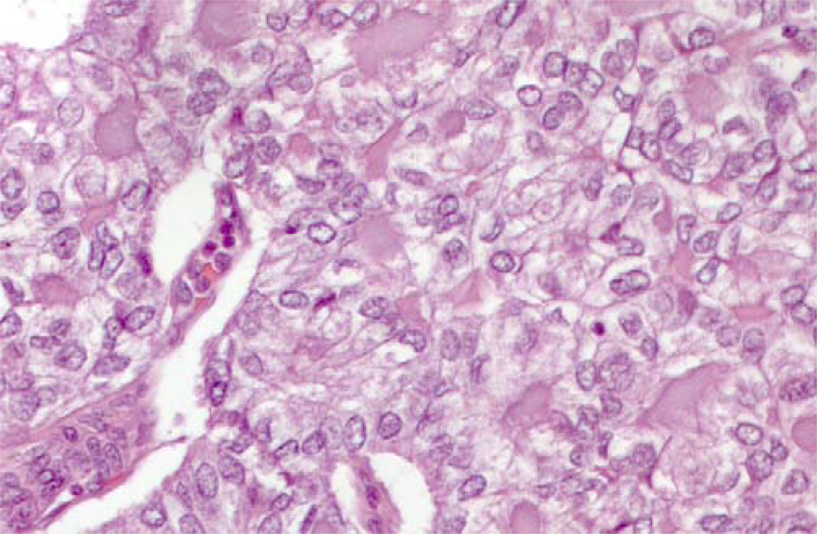 Matched histological sample of papillary carcinoma solid variant. At higher magnification note the nuclear features of the neoplastic cells leading to the morphological diagnosis of PTC in its solid variant. (H&E staining 25×)