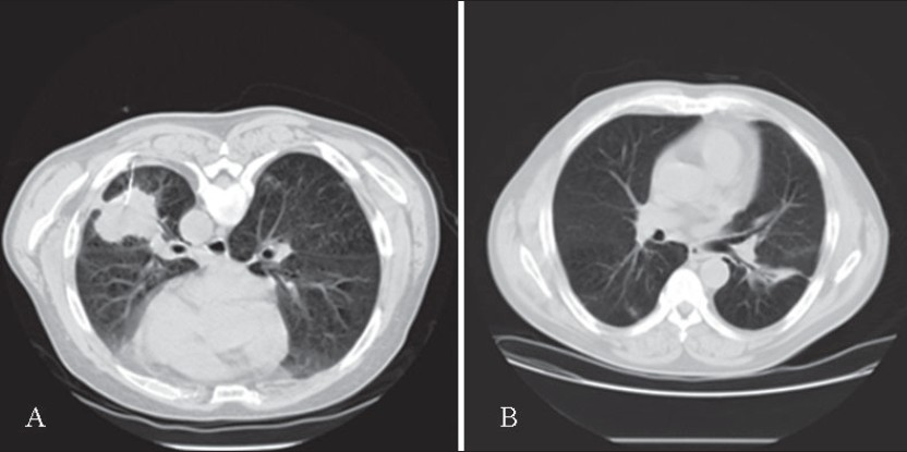 (A) Prone CT chest, placement of 22G Westcott biopsy needle in the left lower lobe mass. (B) Follow up CT chest two months after biopsy. Notice marked improvement with residual inflammation and focal bronchiectasis in the left lower lobe.