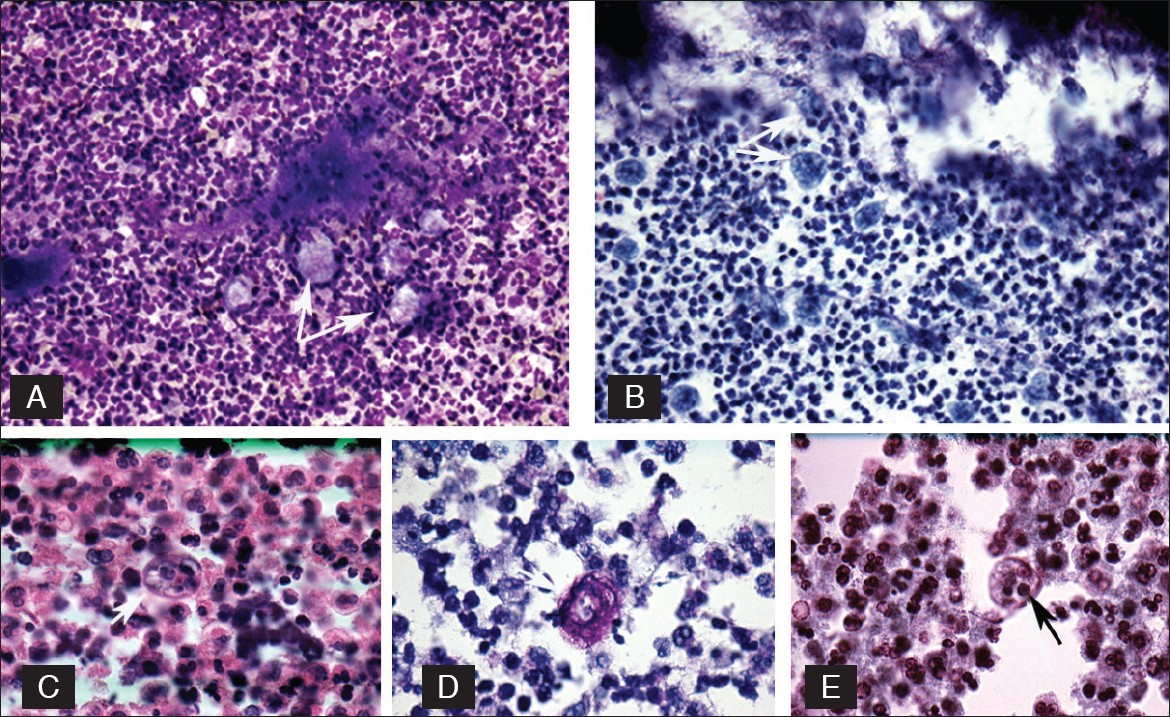 Top row left (A) E. gingivalis seen as pale, irregular, macrophage-like structures (arrow), Diff-Quik, (original) ×160. Right (B) E. gingivalis (arrow) arranged along the actinomyces. Pale food vacuoles are visible, Pap Stain, (original) ×160. Second row left (C) E. gingivalis with thick border, (arrow), H/E. (original) ×400, middle (D) E. gingivalis, periodic acid schiff stain (arrow). (Original) ×630, right (E) E. gingivalis notice the distinct food vacuoles and karyosome (arrow). Wheatley stain. (Original) ×160.