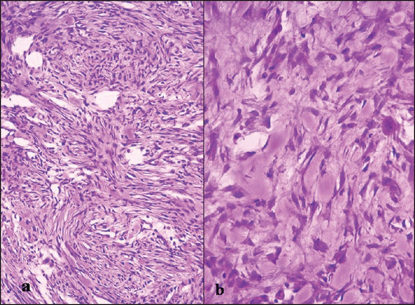 Section from resected nodule — a) spindle-to-oval cells in a storiform pattern (H and E ×150); b) spindle-to-plasmacytoid cells with interspersed ganglionlike cells (arrow) present in collagenous stroma (H and E ×300)