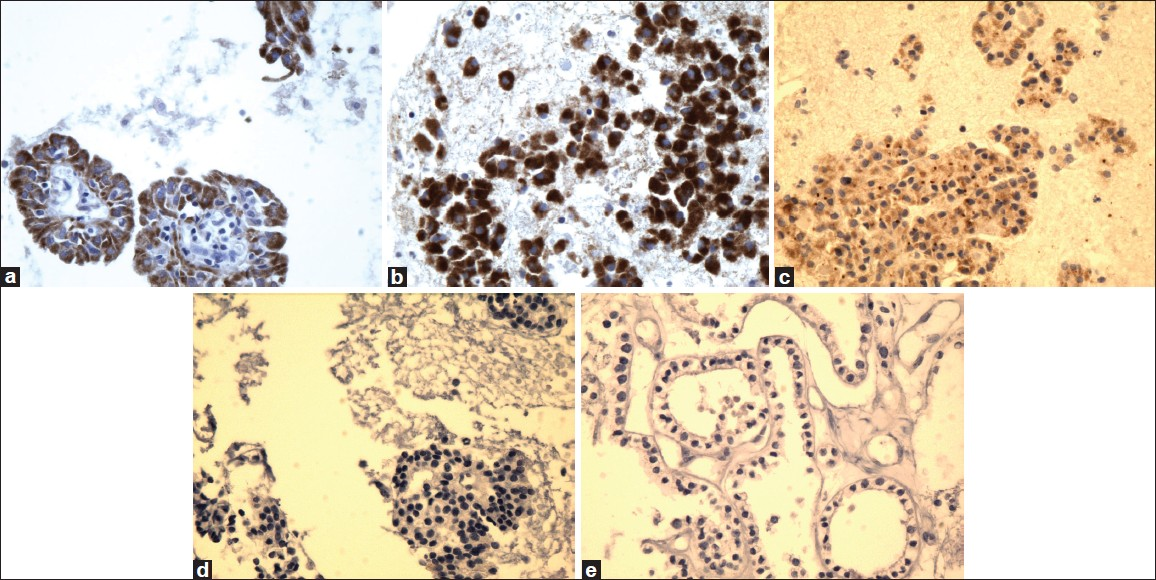 High magnification of Ret oncoprotein immunostain showing reactivity in PTC (a), FVPC (b), and FC (c), and negative reaction for FA (d) and HN (e) (×40, Ret oncoprotein immunostain)