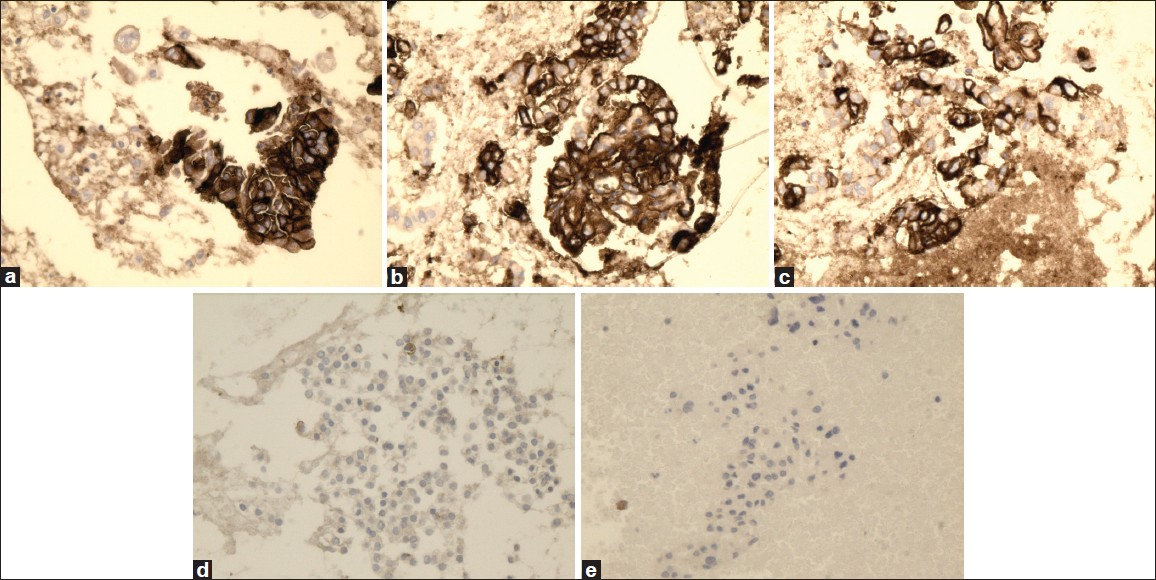 High magnification of HBME-1 immunostain showing reactivity in PTC (a), FVPC (b), and FC (c), and negative reaction for FA (d) and HN (e) (×40, HBME-1 immunostain)