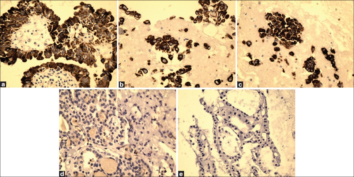 High magnification of CK19 immunostain showing reactivity in PTC (a), FVPC (b), and FC (c), and negative reaction for FA (d) and HN (e) (×40, CK19 immunostain)