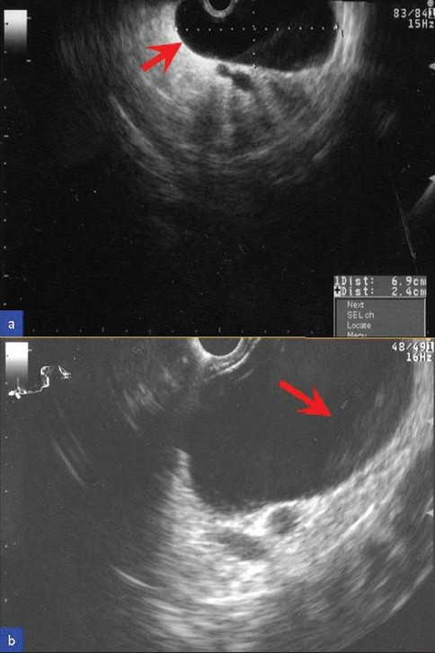 Ultrasound image of the pancreatic cystic lesion. (a) EUS showed a 6.9 × 2.4 cm cyst (arrow) in the pancreatic body–tail region without septae or solid component. (b) Under higher magnification, there is a subtle layering of debris (arrow) within the cyst