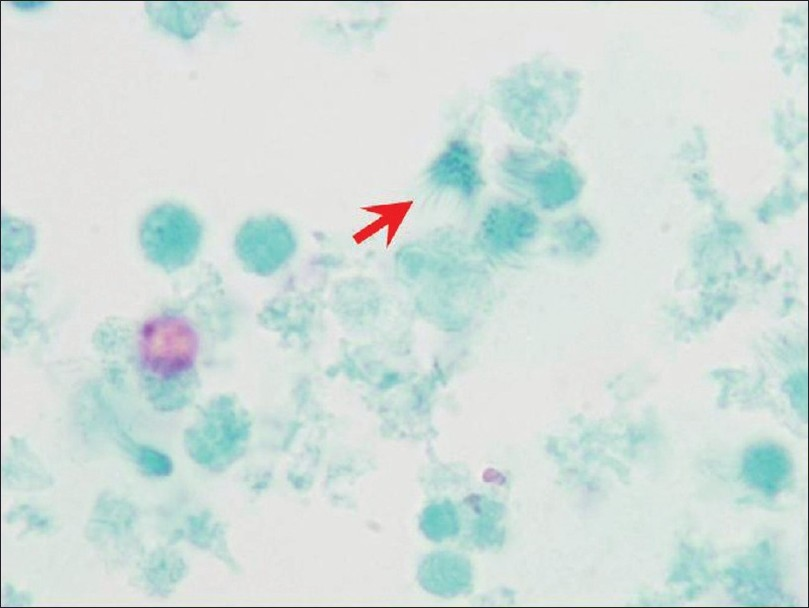 EUS-FNA cytology. The hypocellular preparation predominantly showed debris with detached ciliary tufts (red arrow). Goblet cells and keratinous debris and/or anucleated squamous cells were not present (Papanicolaou-stained SurePath preparation)