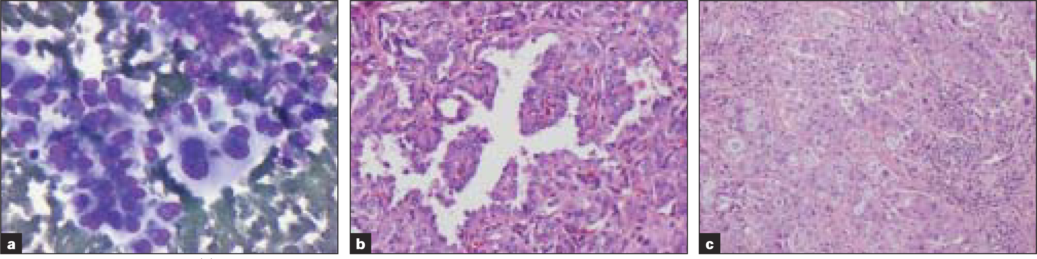 Table 3; Case 3 (a) Aspirate smears reveal pleomorphic cells with eccentric nuclei, macronucleoli and cytoplasmic vacuoles (Diff-Quik® stain) that were mucicarmine positive (b) Histologic sections of the thyroid revealed papillary carcinoma and those of lymph node (c) showed papillary carcinoma with mucinous metaplasia (H&E)