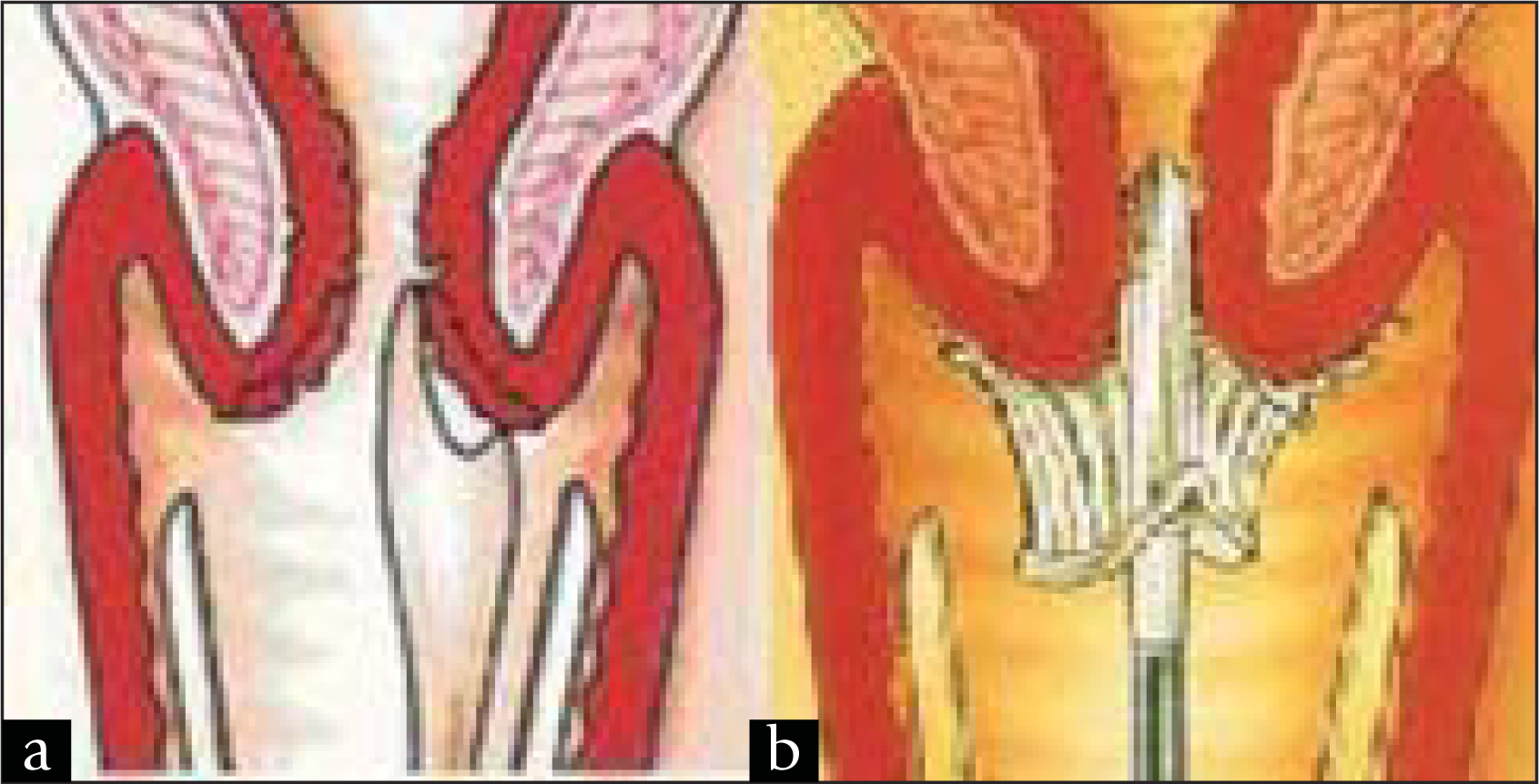 Diagrams showing the use of the (a) extended-tip spatula and (b) Cervex brush to take cervical smears (Images reproduced with permission from Rovers Medical Devices)