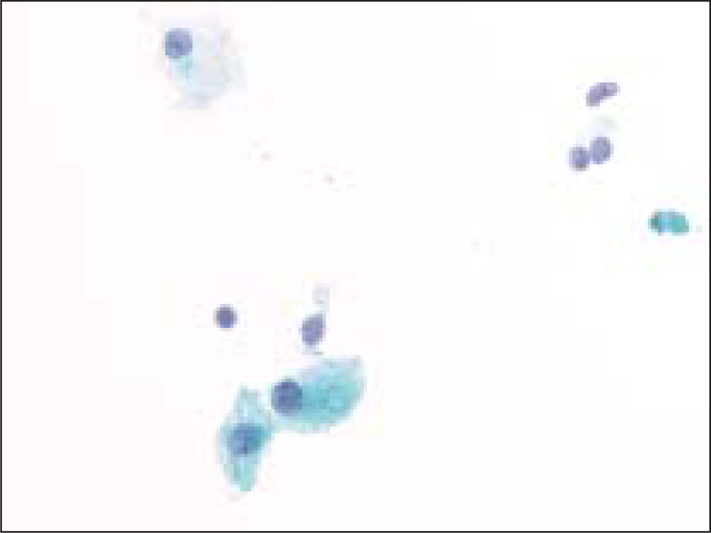 Cystic macrophage in a case of benign colloid nodule (Pap, O.M. ×600)