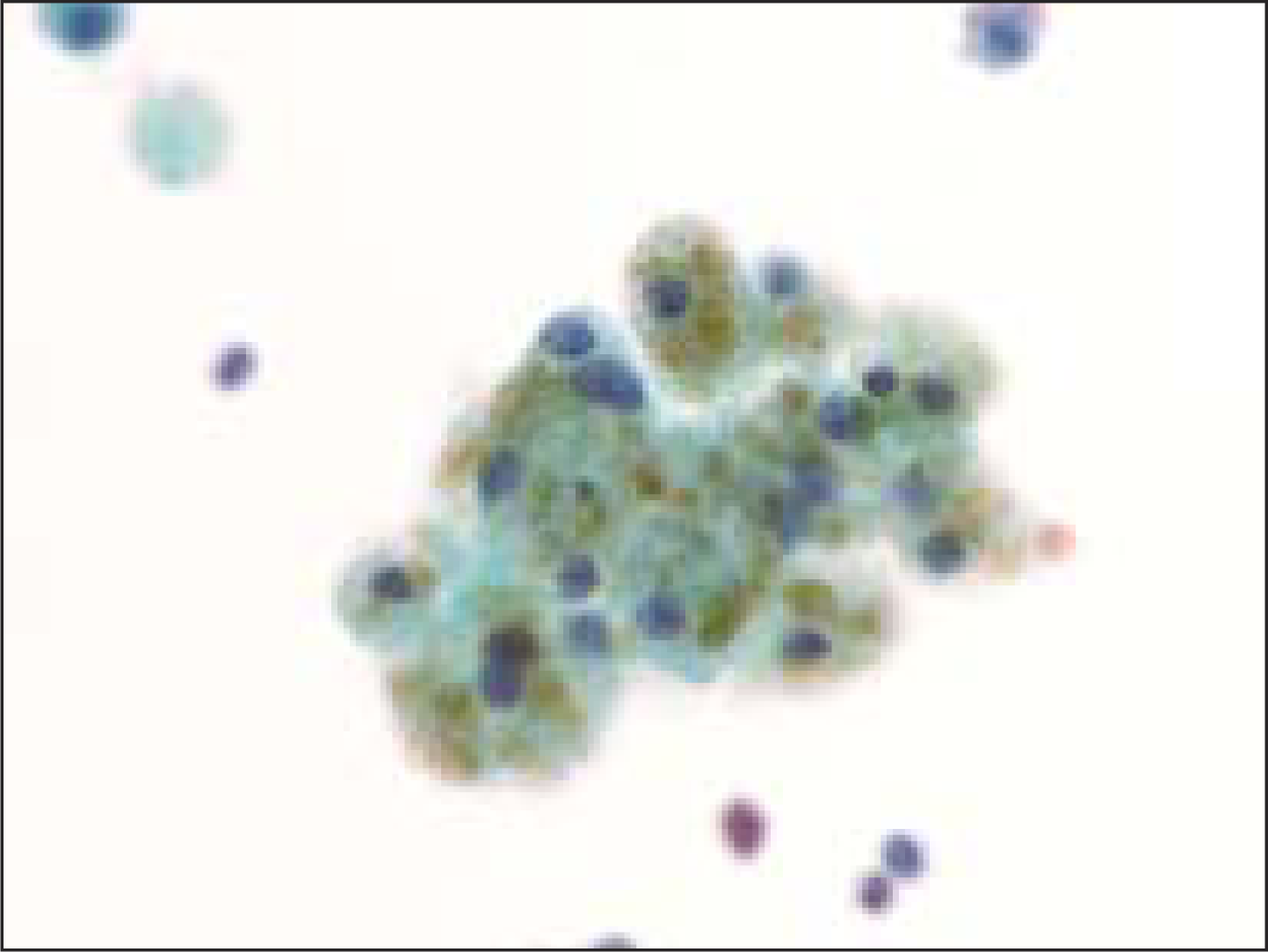 Macrophage With Hemosiderin