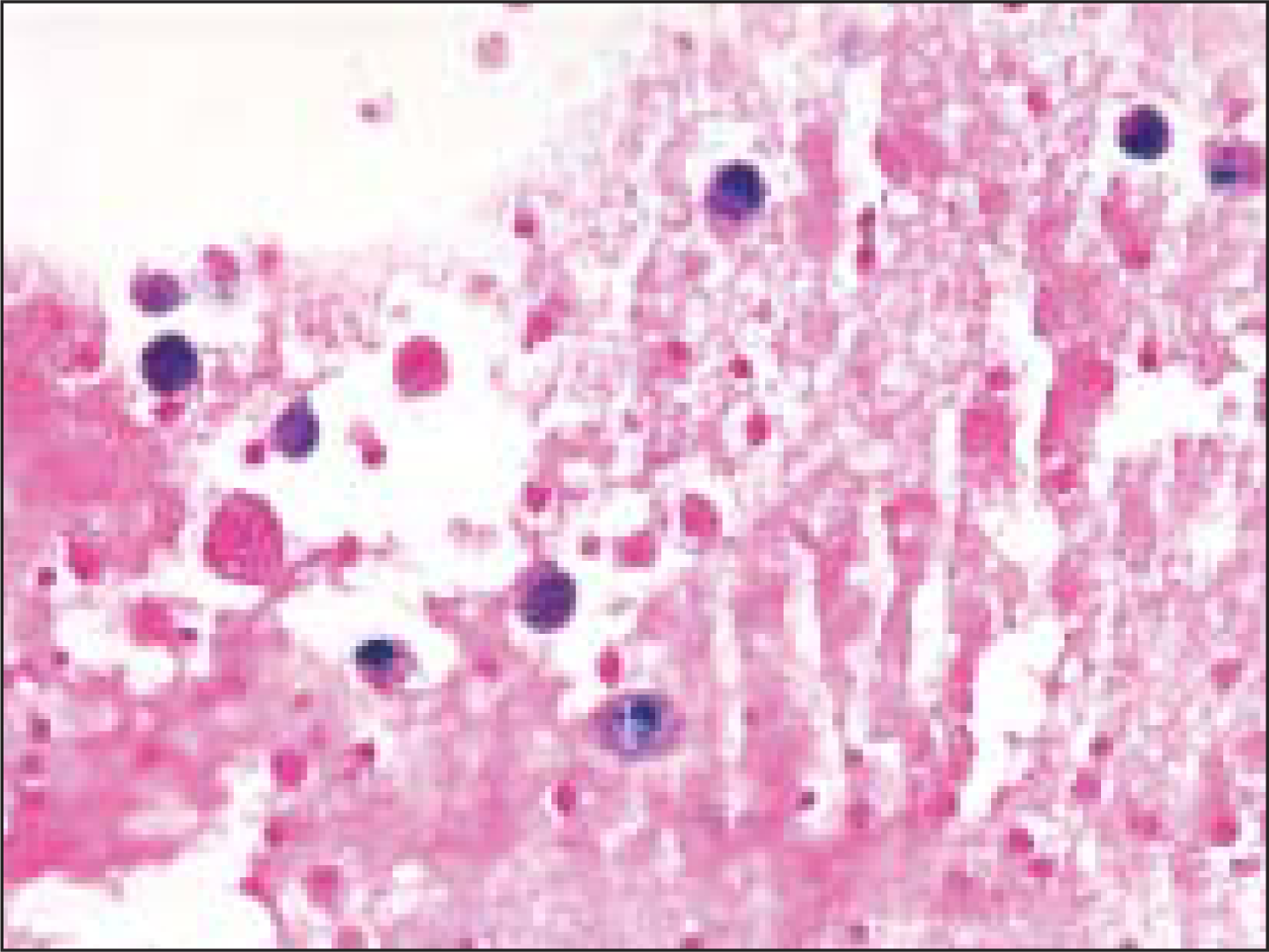 Prussian blue staining demonstrates hemosiderin in macrophages (Pap, O.M. ×400)