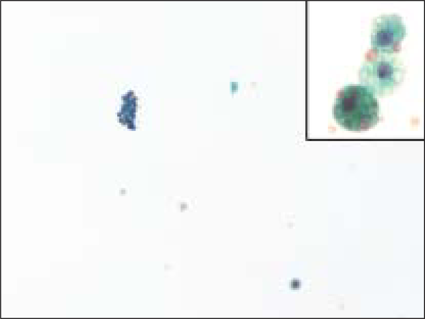 Macrophages were rarely seen in FNA samples that were ultimately diagnosed on resection as a follicular neoplasm. The insert shows a higher magnification of a macrophage from this case, containing hemosiderin (Pap, O.M. ×200; insert is ×600)