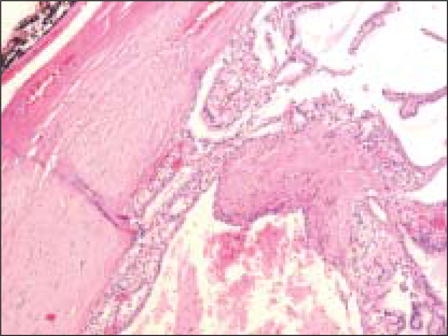 The histologic section from the lesion corresponding to Figure 4 was diagnosed by surgical pathologists as a ‘macrofollicular adenoma’. Note the presence of occasional macrophages within some of the enlarged follicles (Pap, O.M. ×100)