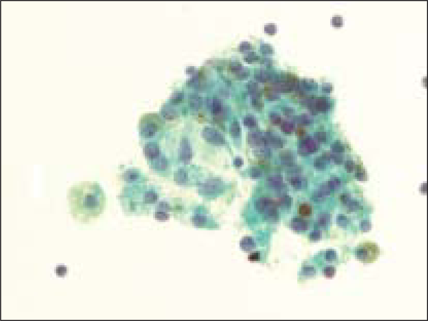 Follicular epithelial cells with hemosiderin granules in a case of benign colloid nodule (Pap, O.M. ×600)