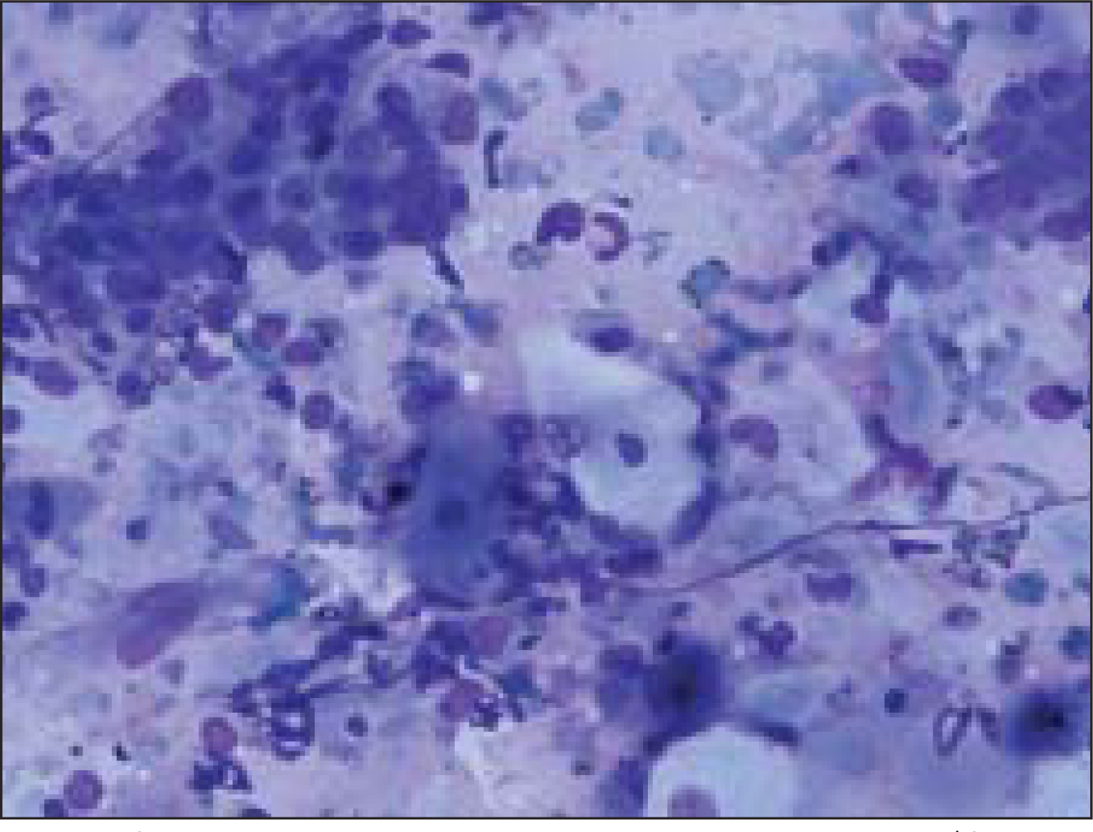 pleomorphic adenoma cytology ppt