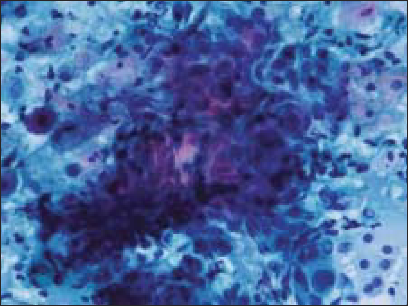 Cluster of basaloid cells with mild nuclear atypia (Papanicoloau stain, ×200×)