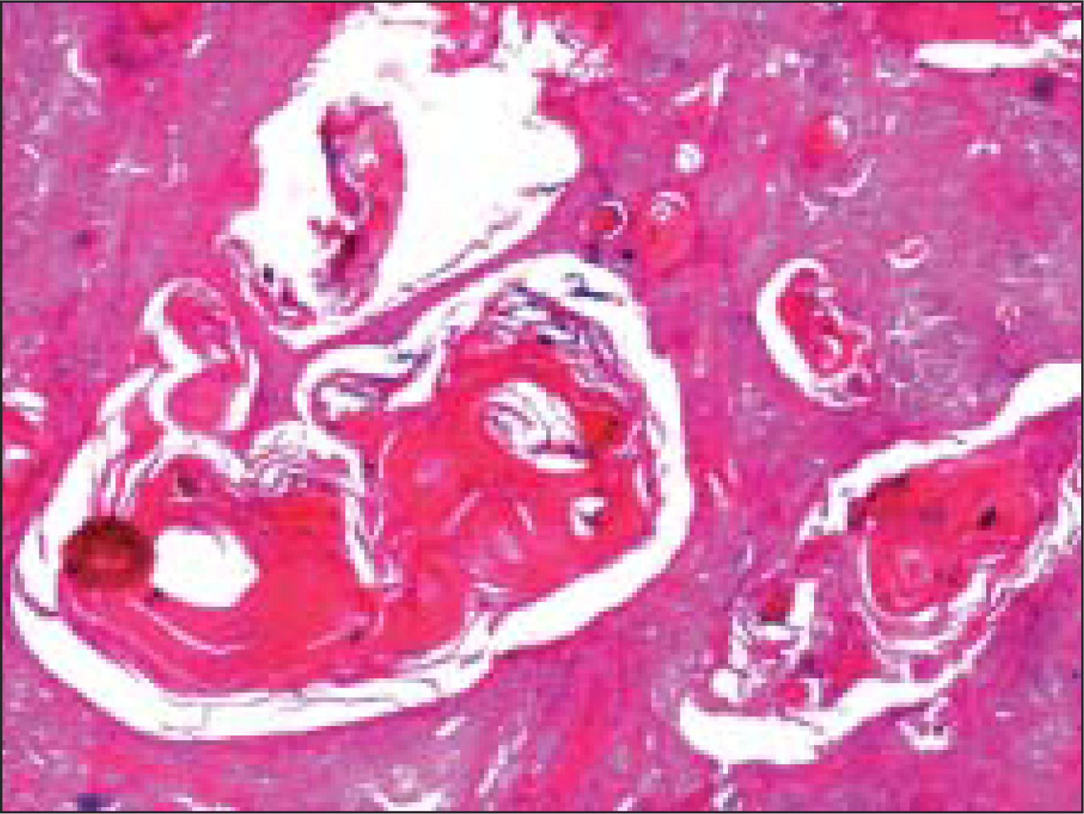 Sheets of squamous cells with multiple keratin filled cysts reminiscent of trichoepitheliomatous differentiation (Hematoxlin and eosin, ×40×)