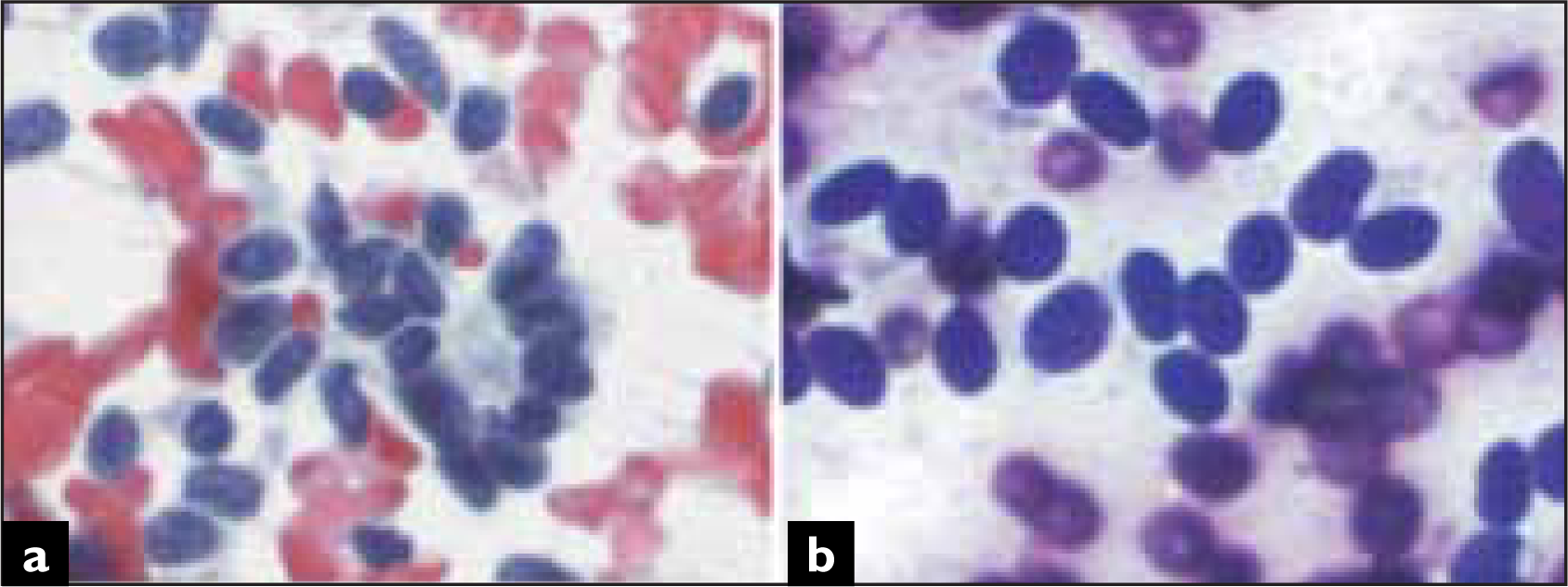 Glandular structures were also evident. Chromatin is regularly distributed and there are no relevant nucleoli (A, Papanicolaou). Cells have inconspicuous cytoplasm and predominantly oval, monomorphic nuclei (B, Diff Quik).