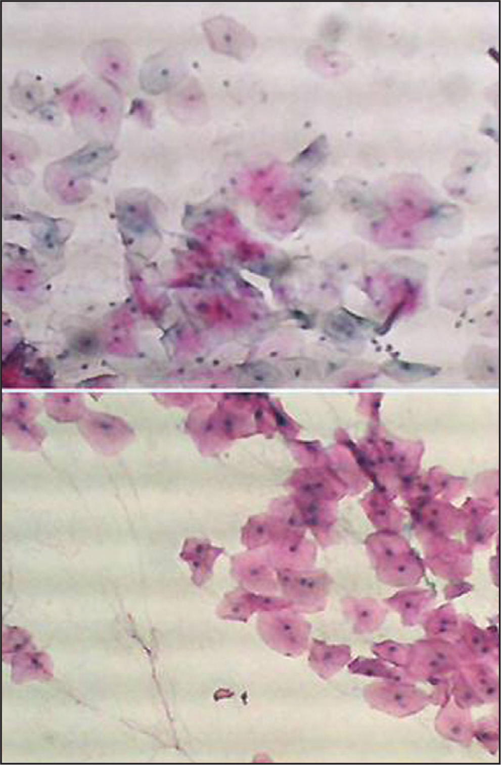 Buccal smear from a patient with head and neck cancer non-exposed to chemotherapy or Radiotherapy. Normal epithelial cells. Pap. × 10