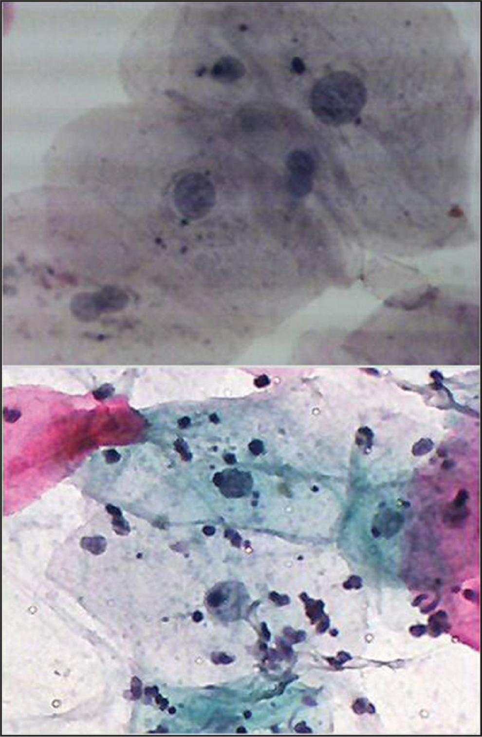 Buccal smear from a patient receiving Radiotherapy with head and neck cancer. Moderate cytological atypia. Increased keratinization with increased N/C ratio and background containing inflammatory cells. Pap. Stain 40×