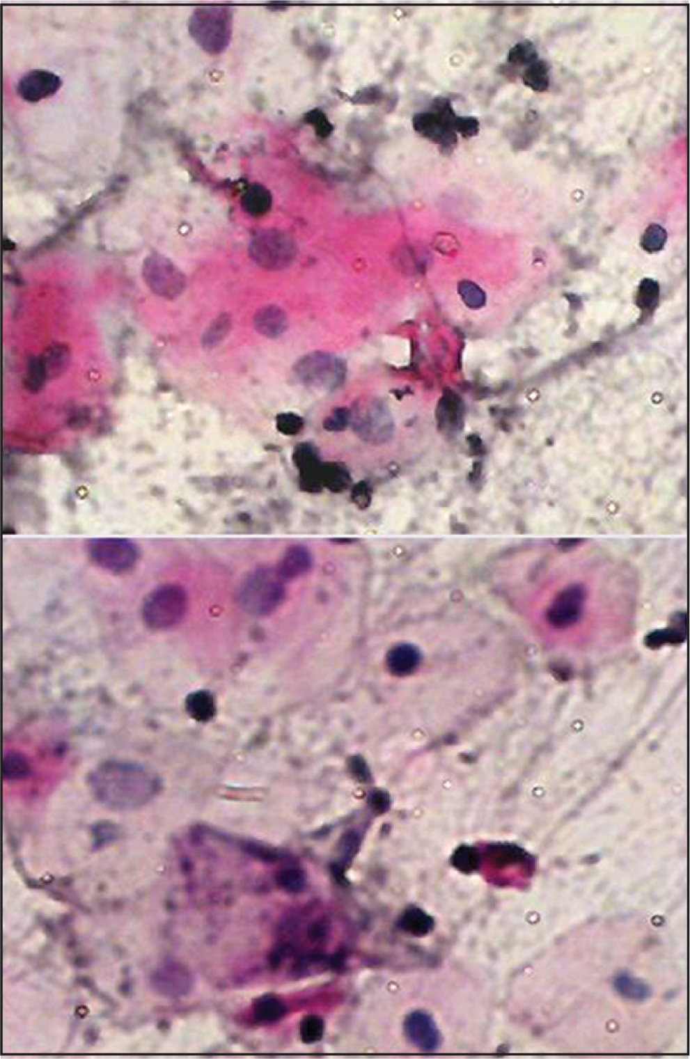 Buccal smear from a patient receiving chemotherapy with carcinoma of hypopharynx. Moderate cytological atypia. Increased keratinization with increased N/C ratio, Hyperchromasia and background containing inflammatory cells. Pap stain ×40