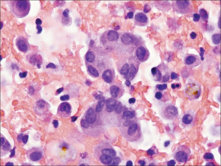 Hepatocellular Carcinoma Cytology