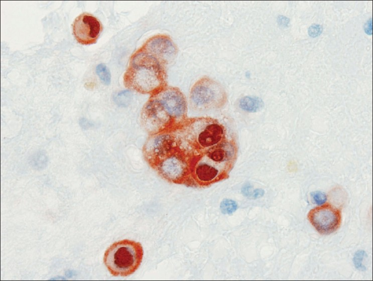 Calretinin immunocytochemical stain from case #1. Clusters and individual cells in the background both stained strongly for calretinin in the cytoplasm and nucleus, confirming the mesothelial origin of the cells of interest in the cell block. (Peroxidase stain, 600× magnification)