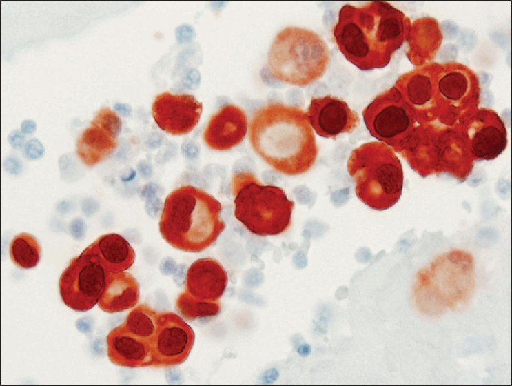 Calretinin immunocytochemical stain from case #2. Diffusely and strongly stained all epithelioid cells in the cell block, confirming mesothelial derivation. (Peroxidase stain, 600× magnification)