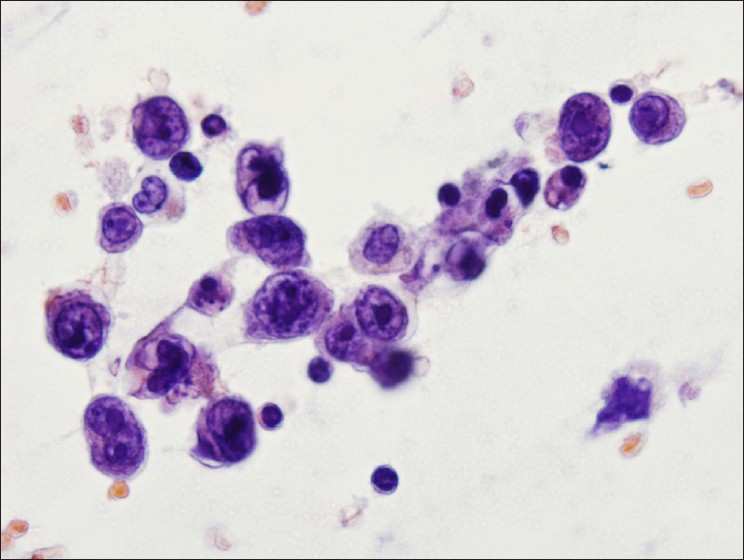 Hepatocellular Carcinoma Cytology