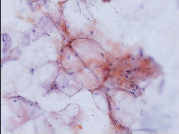 Amyloid on smears: Amyloid appearing as light pink material deposited along the contours of adipocytes (Congo red stain, original magnification × 200)