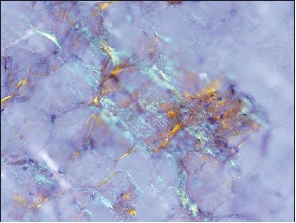 The corresponding polarized light appearance of amyloid with focal apple green birefringence (Original magnification, ×200)