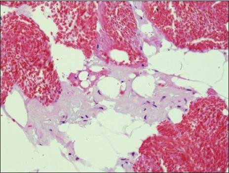 Amyloid on cell blocks: Amyloid appears as glassy faintly esoninophilicmaterial on hematoxylin-eosin stain, deposited around adipocytes (H and E, original magnification × 200)