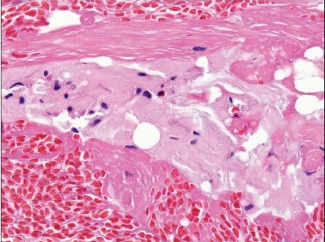 Amyloid sandwiched between two layers of fibrin. Amyloid has an amorphous pink appearance, compared to the deeply pink-red wavy appearance of fibrin (H and E, original magnification × 400)