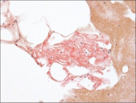 Amyloid appears as pink material deposited between adipocytes (Congo red stain, original magnification × 400).