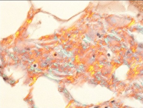 Amyloid displaying focal apple green birefringence under polarized light (C) (Original magnification, × 400)