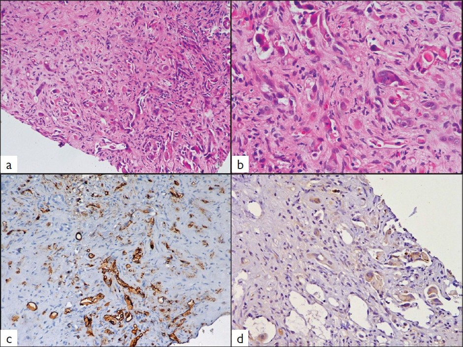 Histological photomicrographs demonstrating singly-lying and cords of cells embedded in a desmoplastic stroma (a, H and E ×100). The tumor cells show intracytoplasmic lumina containing red blood cells (b, H and E ×200). Immunostaining reveals cytoplasmic positivity for CD31 in the tumor cells (c, ×100) and focal positivity for pancytokeratin (d, ×200).