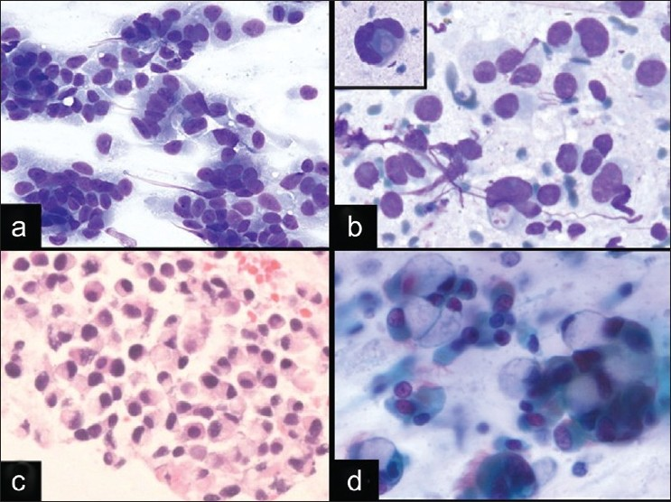 Signet-ring adenocarcinoma in EBUS FNA and diagnostic pitfall. a, b) An EBUS FNA of demonstrates loosely cohesive tumor cells with relatively homogeneous nuclei, variable amounts of glassy cytoplasm, and some plasmacytoid cells (a. DQ stain, ×400; B. DQ stain, ×600). Occasional cells have marked nuclear enlargement, prominent nucleoli, and cytoplasmic vacuolization (b inset. DQ stain, ×600). c) Cell block from signet-ring adenocarcinoma (HandE stain, ×400). d) Goblet cell metaplasia from bronchial contamination (Pap stain, ×600) can mimic signet-ring adenocarcinomas.