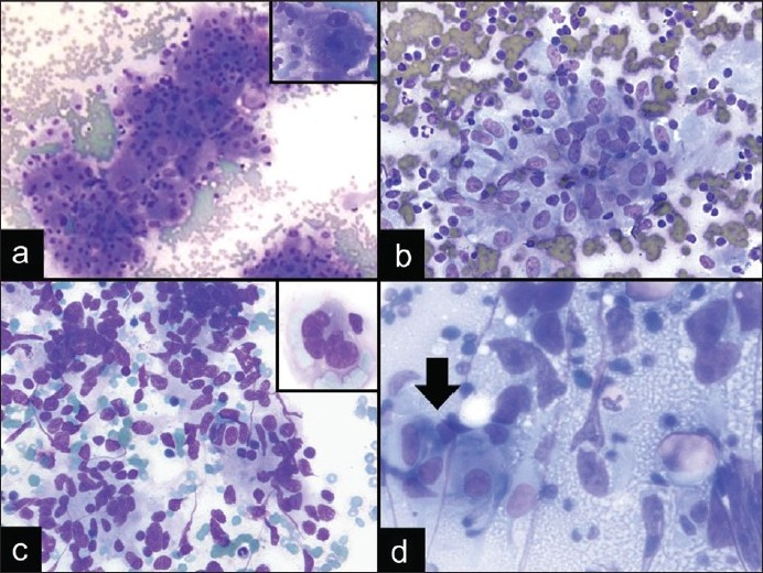 Diagnostic pitfalls of granulomatous inflammation in EBUS FNA. a) Metastatic RCC with occasional cells showing nuclear enlargement and large prominent nucleoli (DQ stain, ×200; inset: DQ stain, ×600). b) Nonnecrotizing granulomatous inflammation in a patient with sarcoidosis (DQ stain, ×400). c) Spindle cell melanoma with spindle-shaped nuclei that resemble epithelioid histiocytes (DQ stain, ×400; inset: DQ stain, ×600). d) Malignancies, such as mediastinal germ cell tumors, can also be associated with granulomas (DQ stain, ×600; arrow indicates granuloma)