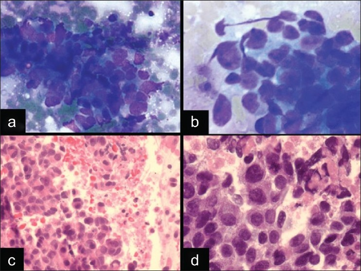 A case of LCNEC in EBUS FNA. a, b) The cytomorphology shows loosely cohesive clusters of cells with nuclear molding, hyperchromasia, and crush artifact, which mimics a small cell carcinoma (a. DQ stain, ×400). However, there are also cells with more abundant cytoplasm and prominent nucleoli (b. DQ stain, ×600). c,d) The cell block showed areas of necrosis and highlights the eosinophilic cytoplasm of the tumor cells, which is most consistent with a LCNEC [(H and E stain, ×400 (C) and ×600 (D)]