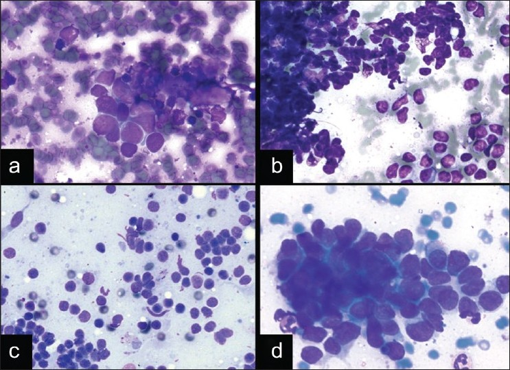 Neuroendocrine carcinomas and pitfalls in EBUS FNA. a) Small cell carcinoma showing nuclear molding, scant cytoplasm, inconspicuous nucleoli, and an apoptotic background (DQ stain, ×400). b) Lymphoma showing pseudo-epithelioid clustering, crush artifact, and a background of lymphoglandular bodies (DQ stain, ×200). c) Benign lymphocytes of a reactive lymph node in EBUS (DQ stain, ×200). d) Basaloid squamous cell carcinoma, which is a nonsmall cell carcinoma that can mimic neuroendocrine carcinomas (DQ stain, ×400)