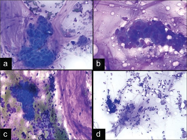 Pitfalls of a mucinous background. a) Squamous cell carcinoma showing clusters of cells with nuclear pleomorphism and dense cytoplasm in a background of mucinous material with histiocytes, inflammatory cells, and bronchial cells from bronchial contamination (DQ stain, ×200). b) Mucinous adenocarcinoma with tumor cells floating in a background of mucinous material without inflammatory cells or macrophages (DQ stain, ×400). c) Small cell carcinoma with a mucinous background (DQ stain, ×200). d) Nondiagnostic EBUS FNA with bronchial contamination (DQ stain, ×200)