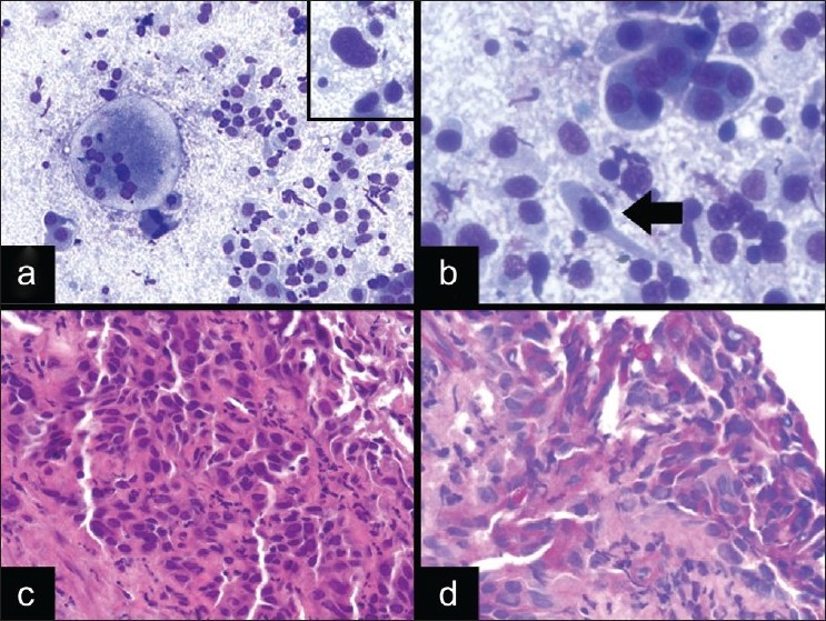 Squamous cell carcinoma with a tigroid background. a) There are discohesive cells with nuclear enlargement and pleomorphism, in a tigroid-like background with multinucleated giant cells (DQ stain, ×200; A inset, ×600). b) The tumor cells have dense cytoplasm and occasional tadpole cells (arrow) are also seen (DQ stain, ×600). c) The corresponding lung biopsy showed an invasive poorly differentiated squamous cell carcinoma (H and E stain, ×400). d) PAS stain performed on the biopsy highlighted the glycogen within the tumor cells, and was digested with diastase (PAS stain, ×400)