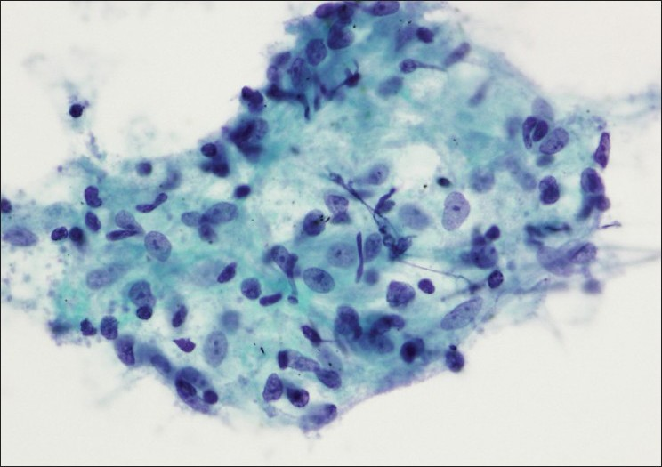 A lymph node aspirate reveals a cluster of epithelioid histiocytes consistent with granulomatous inflammation (Papanicolaou stain)