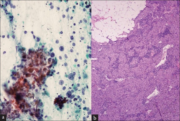 (a) Aspirate contains highly atypical cells and apoptotic bodies in a background of lymphocytes interpreted as metastatic carcinoma (Papanicolaou stain). (b) The resected lymph node contains granulomatous changes with lymphoid depletion and fatty replacement consistent with therapy-related changes (H and E stain)