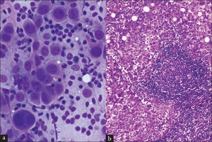 (a) An aspirate from a false-positive lymph node that contains malignant cells in a background of lymphocytes (Diff-Quik stain). (b) The resected lung mass shows the malignant cells infiltrated with lymphocytes (H and E stain)