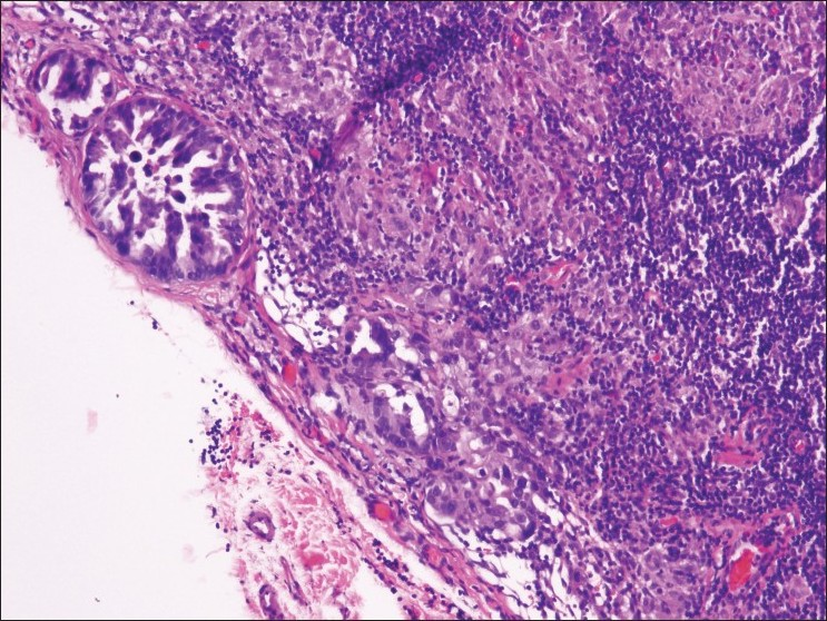 Resected lymph node shows microscopic subcapsular foci of metastatic carcinoma that was not detected on EBUS-TBNA biopsy (H and E stain)