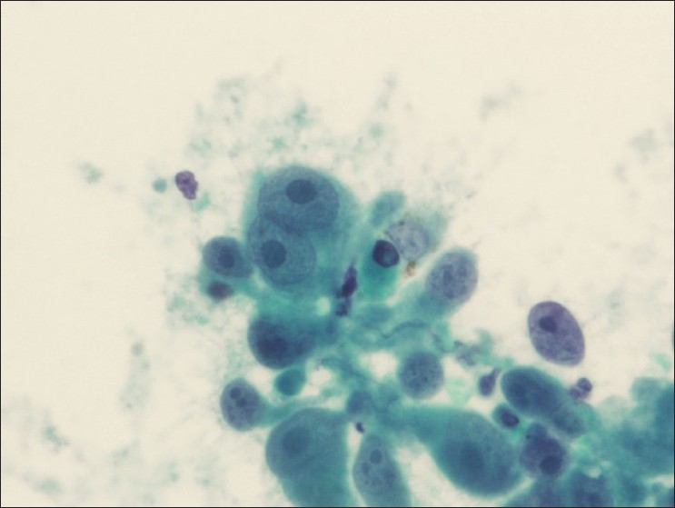 Lymph node aspirate reveals metastatic melanoma (Papanicolaou stain)