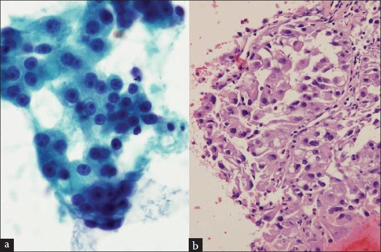 (a and b) A lymph node aspirate, smears and cell block preparation, shows malignant cells consistent with metastasis from known renal cell carcinoma (a, Papanicolaou stain; b, H and E stain)