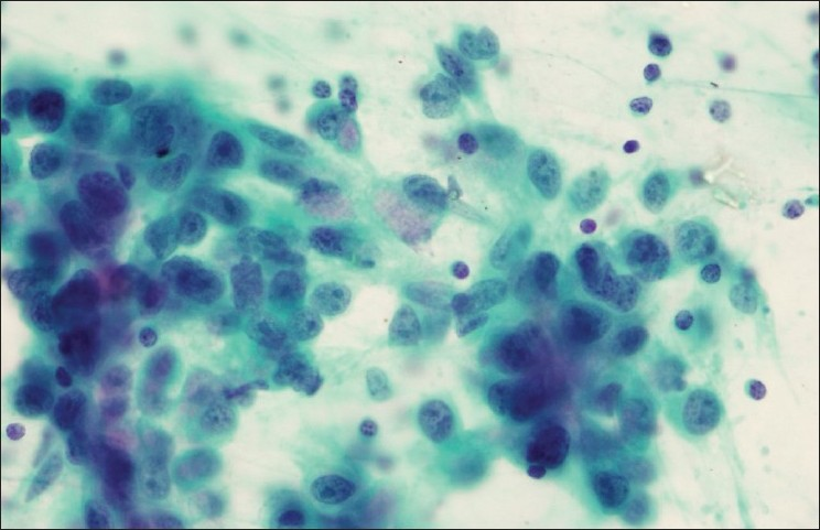 Lymph node aspirate from a patient with a history of esophageal carcinoma reveals metastatic adenocarcinoma (Papanicolaou stain)