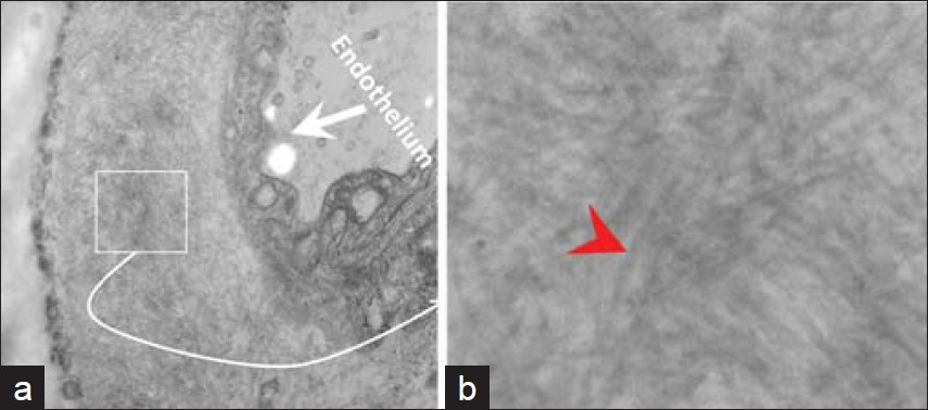 The anterior fat pad aspirate showed amyloid (small box) in the wall of small blood vessels (a). The non-branching random amyloid fi brils with 8.6 nμ diameter were consistent with amyloid (red arrowhead) (b). [Epoxy embedded Glutaraldehyde fi xed section, stained with uranyl acetate and lead citrate. Ultrastructure]