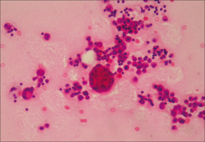 Malignant mesothelioma showing giant atypical mesothelial cells and cell ball formation (H and E, ×400)